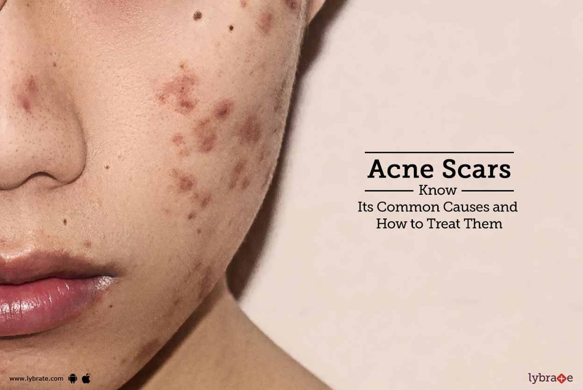 10 Secret Things You Didn't Know About acne