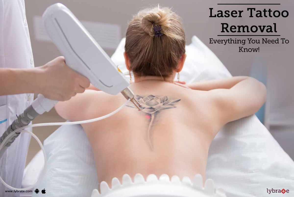 Tattoo Removal Cost in Bangalore  Get Best Price
