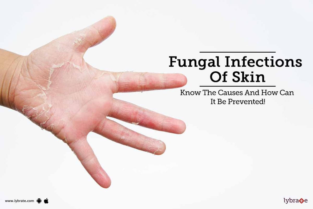 Fungal infection on a man's hand, illustration. Known as ringworm