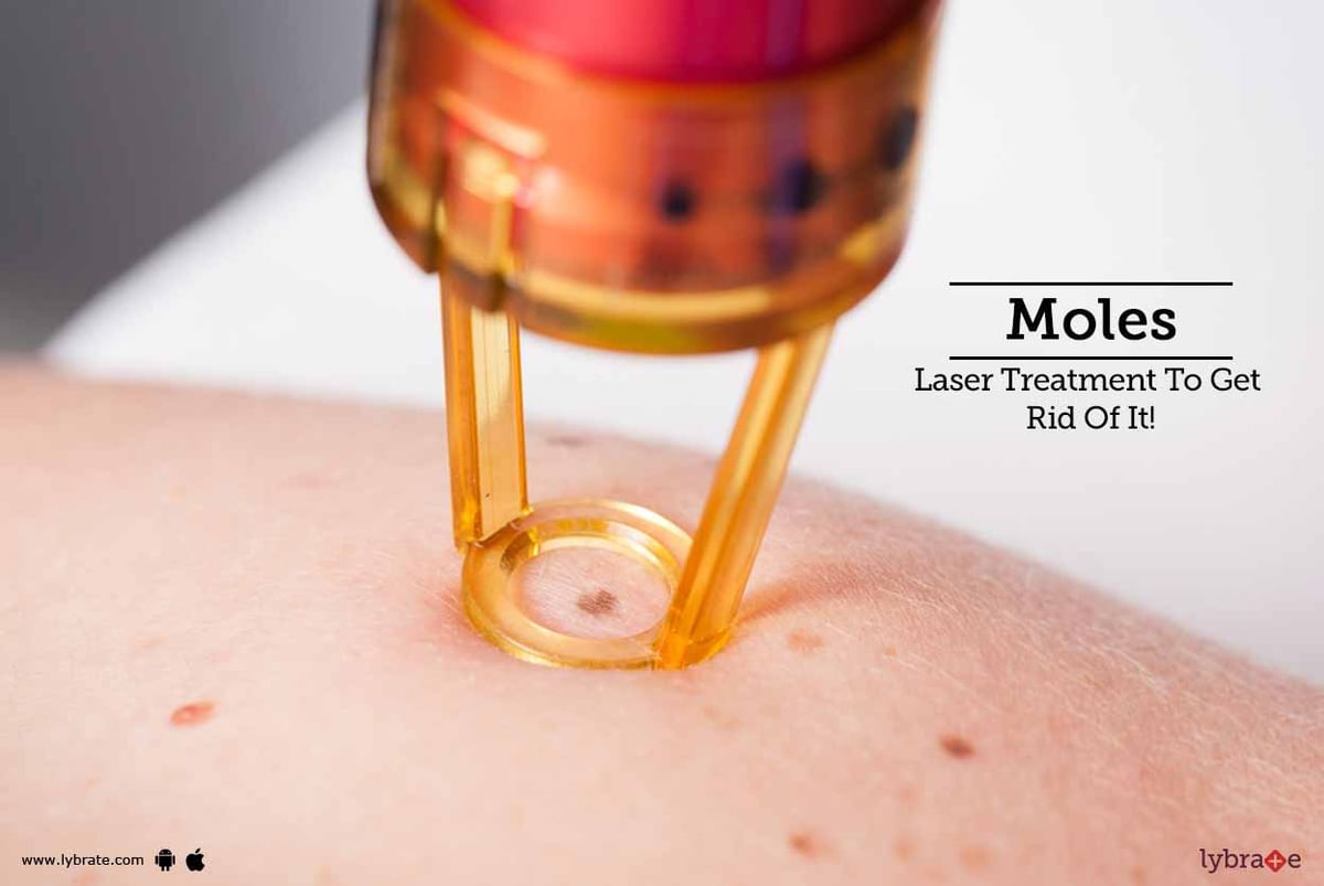 Moles Laser Treatment To Get Rid Of It By Dr Himanshu Singhal Lybrate 