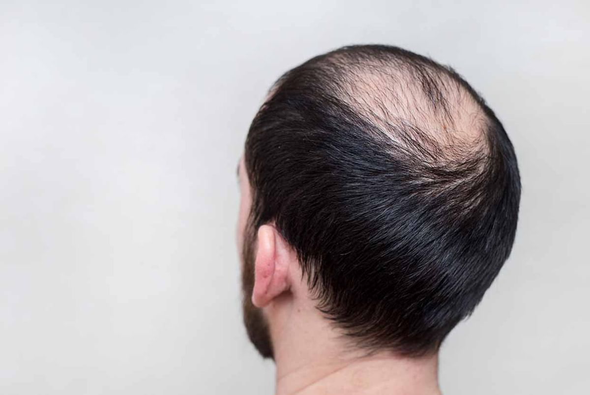 Hereditary Baldness - How It Can Be Treated? - By Hairline International |  Lybrate