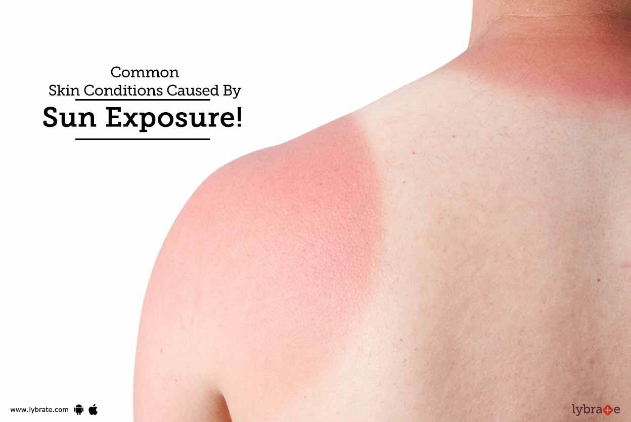 Common Skin Conditions Caused By Sun Exposure! By Dr. Ramesh Gosavi