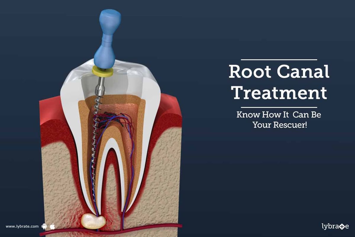 Root Canal Treatment - Know How It Can Be Your Rescuer! - By Dr. Puneet ...