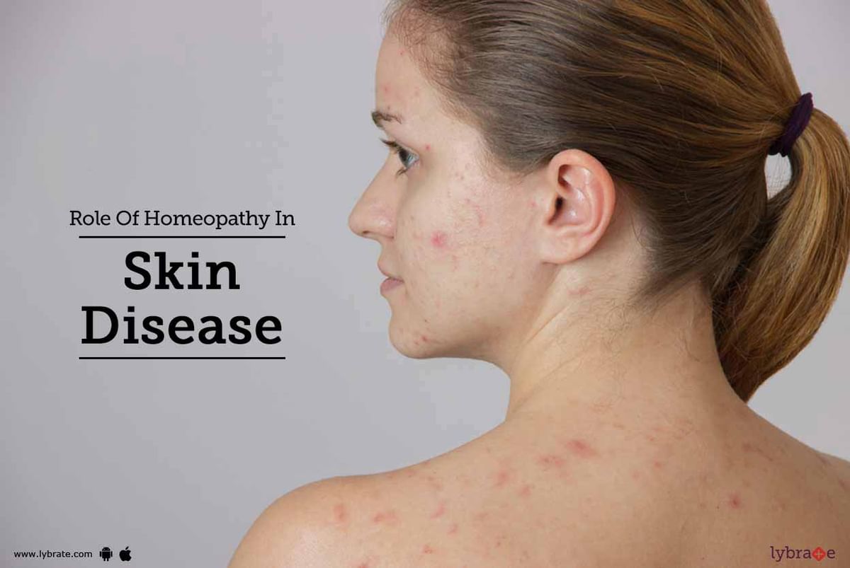 Role Of Homeopathy In Skin Disease - By Dr. Pradnya Mulay | Lybrate