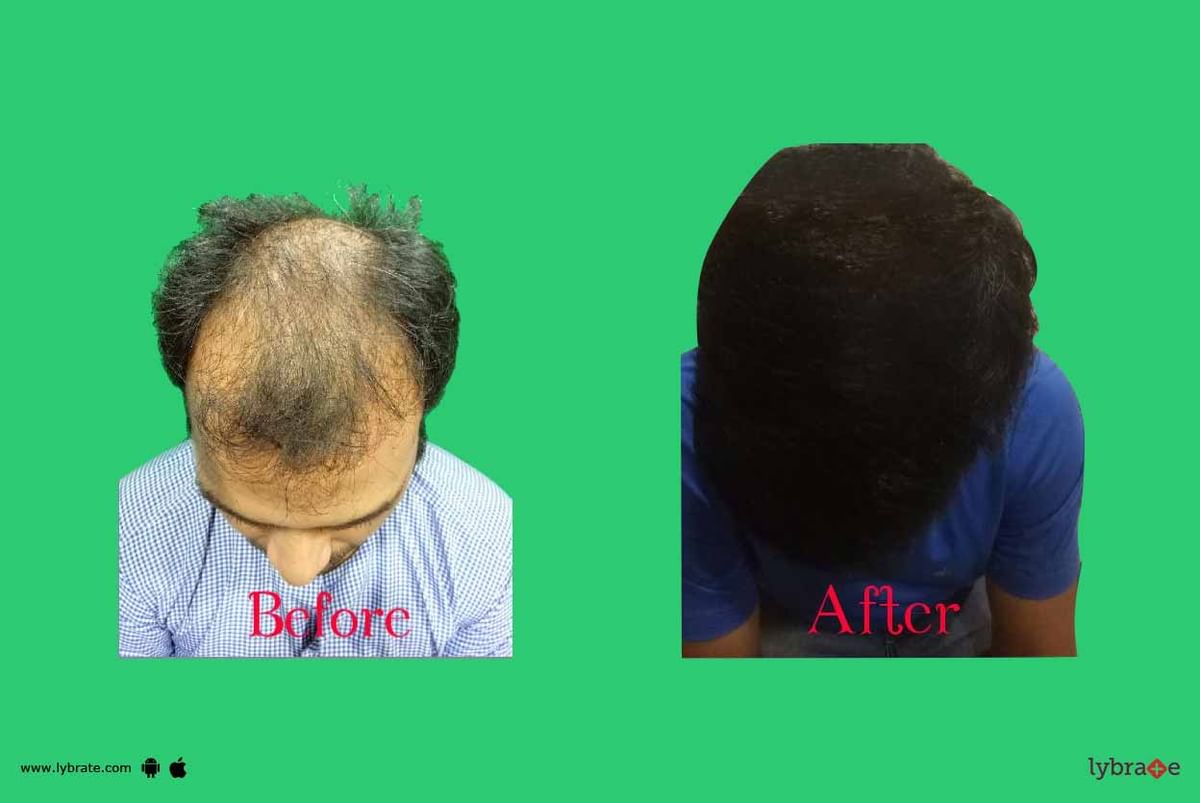 Single Sitting Mega Hair Transplant! - By Dr. Ashish Sangvikar | Lybrate Single Sitting Mega Hair Transplant! - By Dr. Ashish Sangvikar | Lybrate