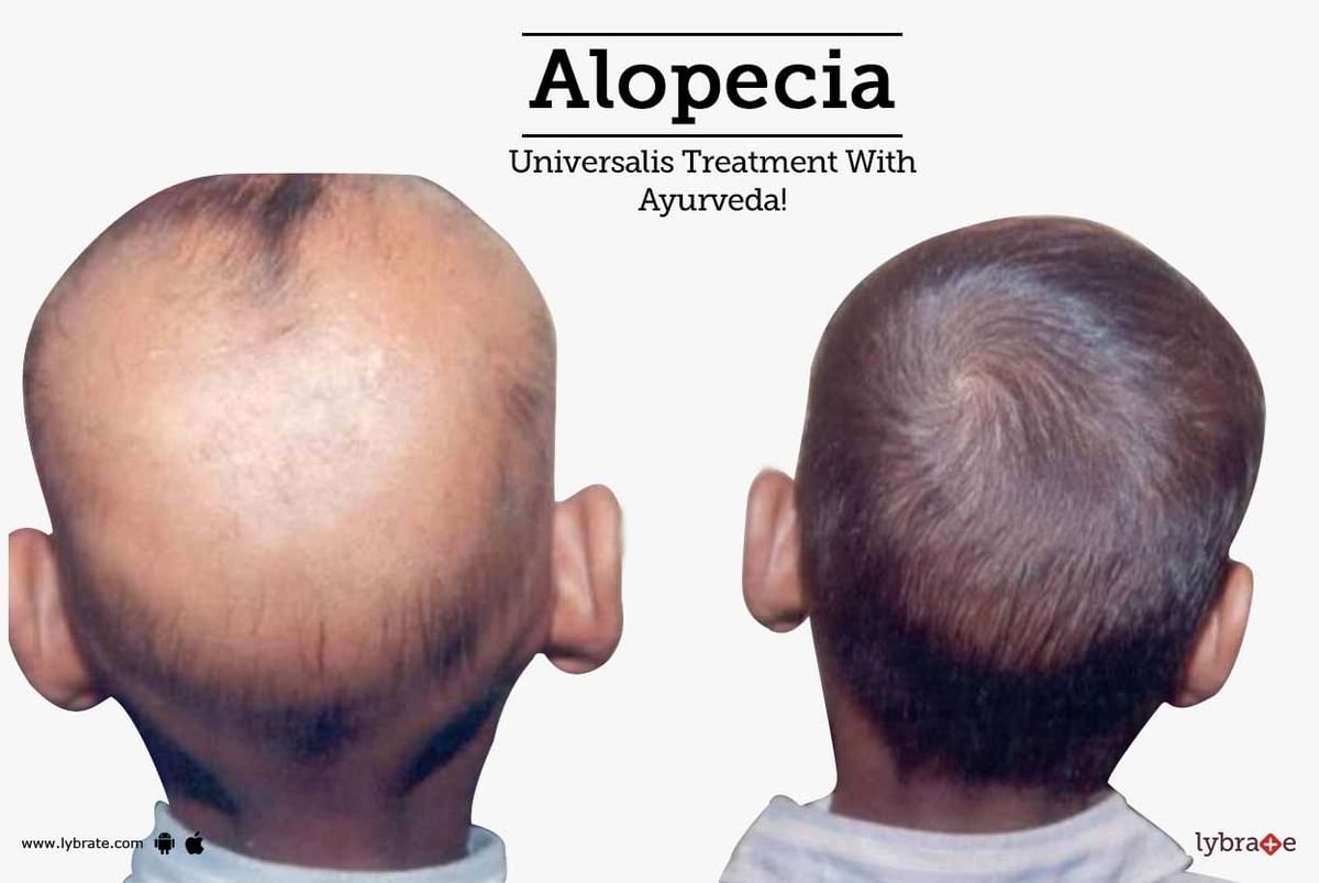 Alopecia Universalis Treatment With Ayurveda! - By Dr. Ritesh Chawla |  Lybrate