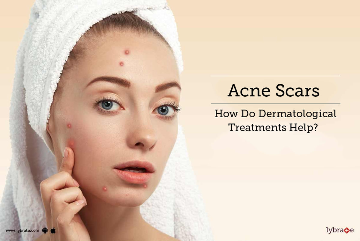 Acne Scars - How Do Dermatological Treatments Help? - By Dr. Umesh ...