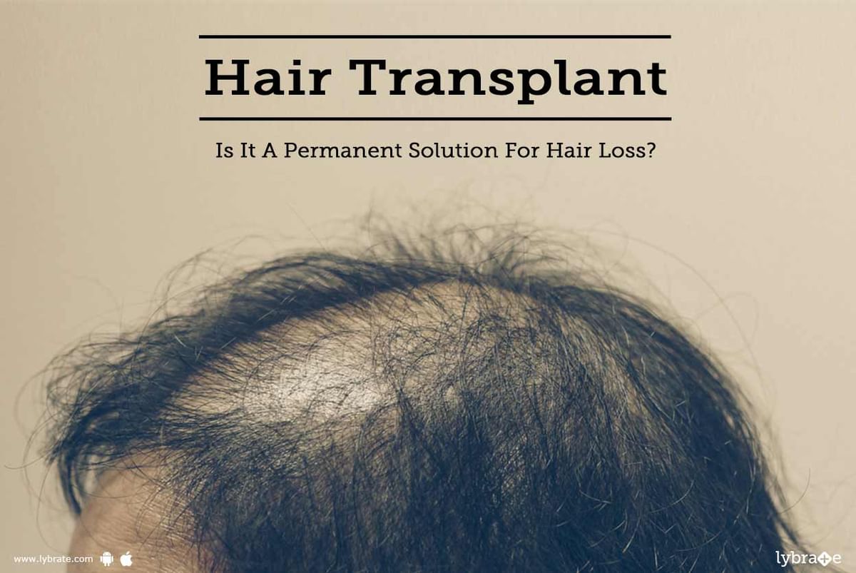 Hair Transplant: Is It A Permanent Solution For Hair Loss? - By Dr.  Rajeshwari K A Bhat | Lybrate