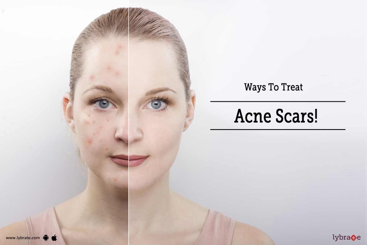 Ways To Treat Acne Scars! - By Dr. Arshi Rahul | Lybrate