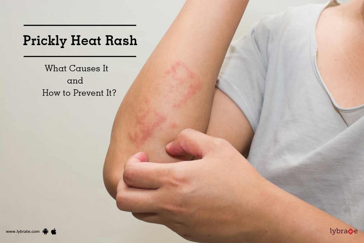 Heat rash (prickly heat)