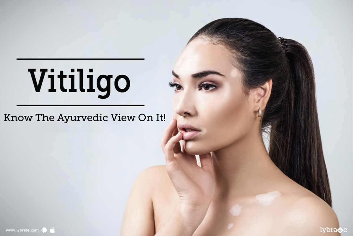 Vitiligo - Know The Ayurvedic View On It! - By Dr. Ravish Kamal | Lybrate