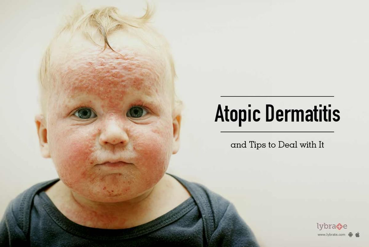 Atopic Dermatitis and Tips to Deal with It - By Dr. Latika Arya | Lybrate