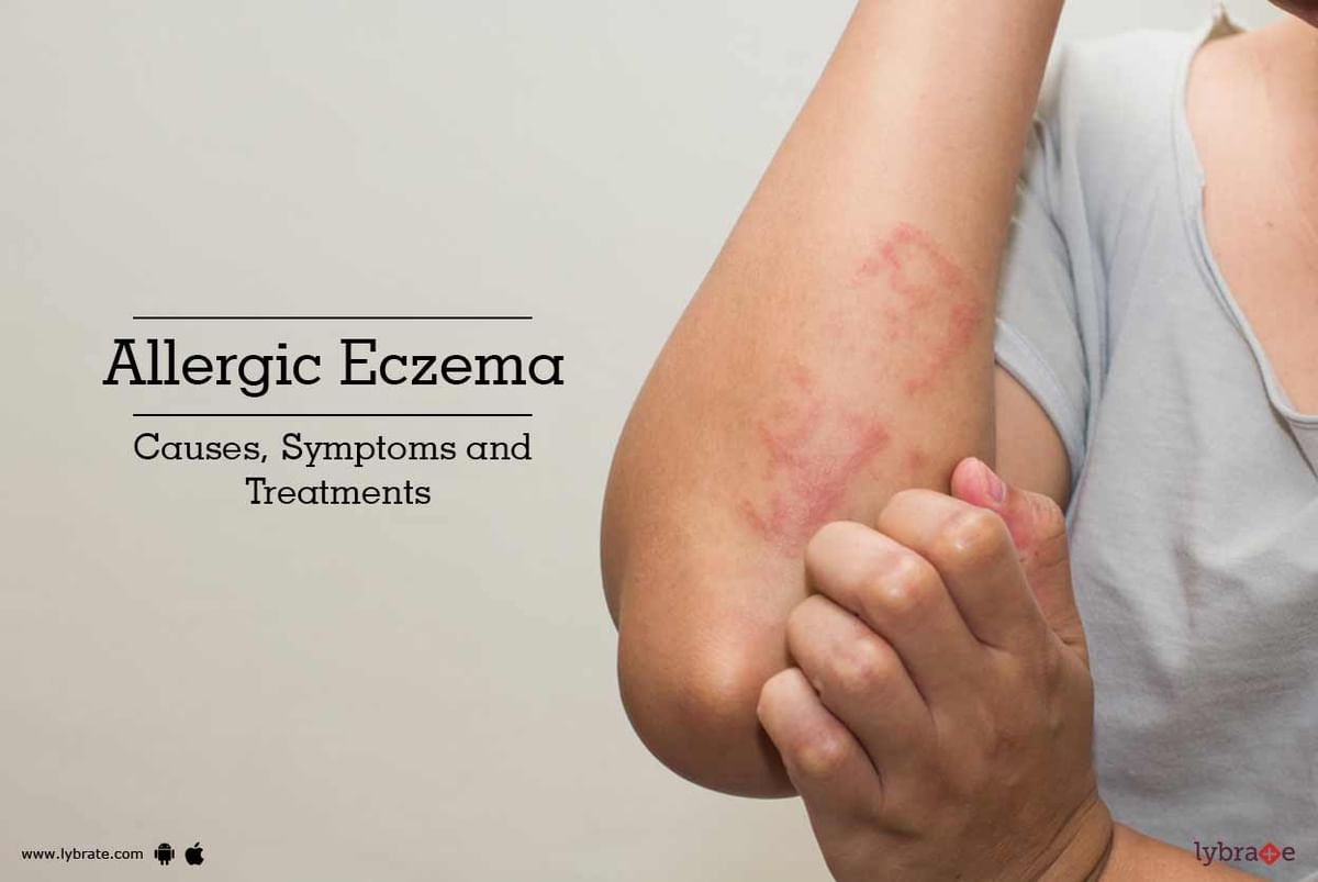 Allergic Eczema Causes Symptoms And Treatments By Dr Molly Joseph Lybrate 