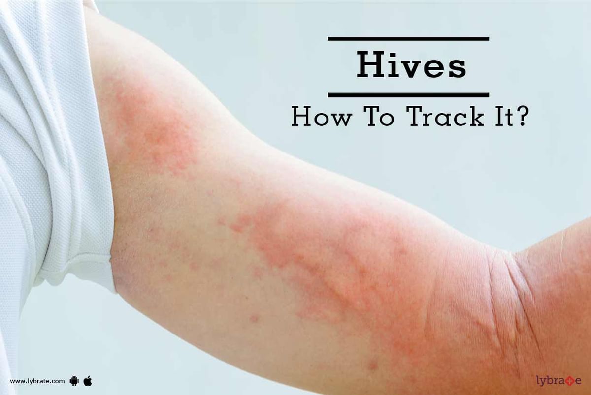 Hives - How To Track It? - By Dr. Nadia Zakir | Lybrate