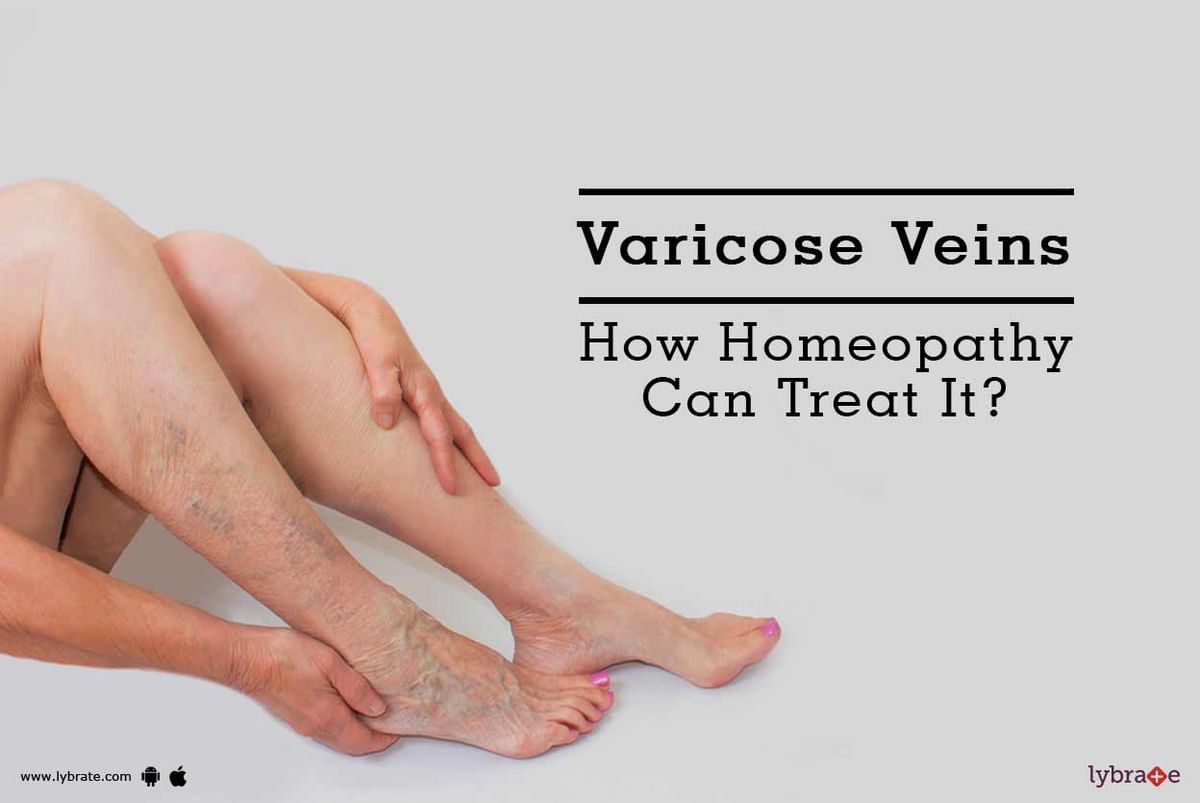 How Physiotherapy Helps in Treating Varicose Veins? - Pristyn Care