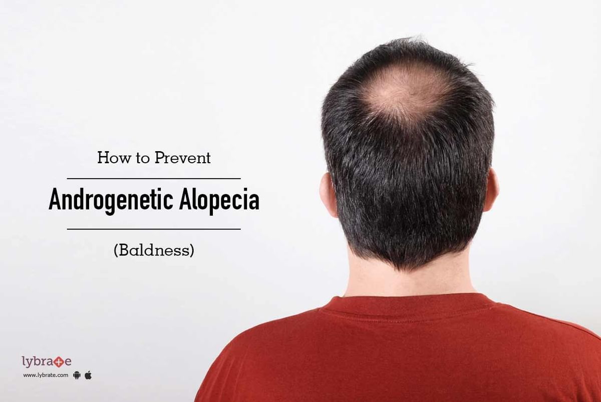 How to Prevent Androgenetic Alopecia (Baldness) Naturally - By Dr. Vignessh  Raj | Lybrate