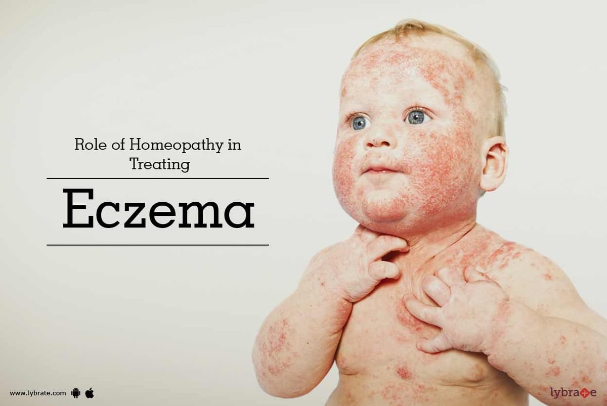 Role Of Homeopathy In Treating Eczema By Dr Sameer Kumar Singh Lybrate   4e9529 