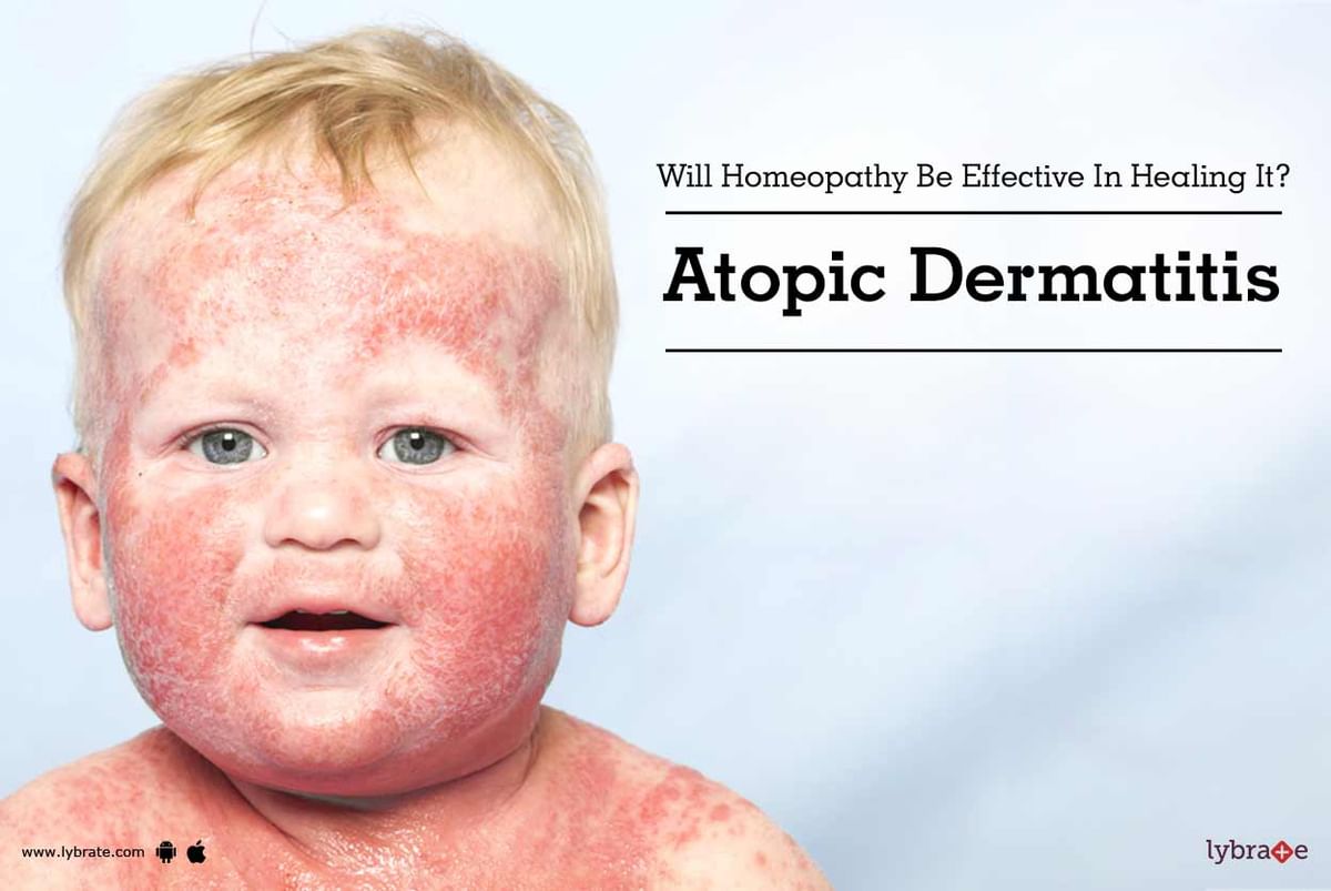 Atopic Dermatitis Will Homeopathy Be Effective In Healing It By Dr Samreth Lybrate