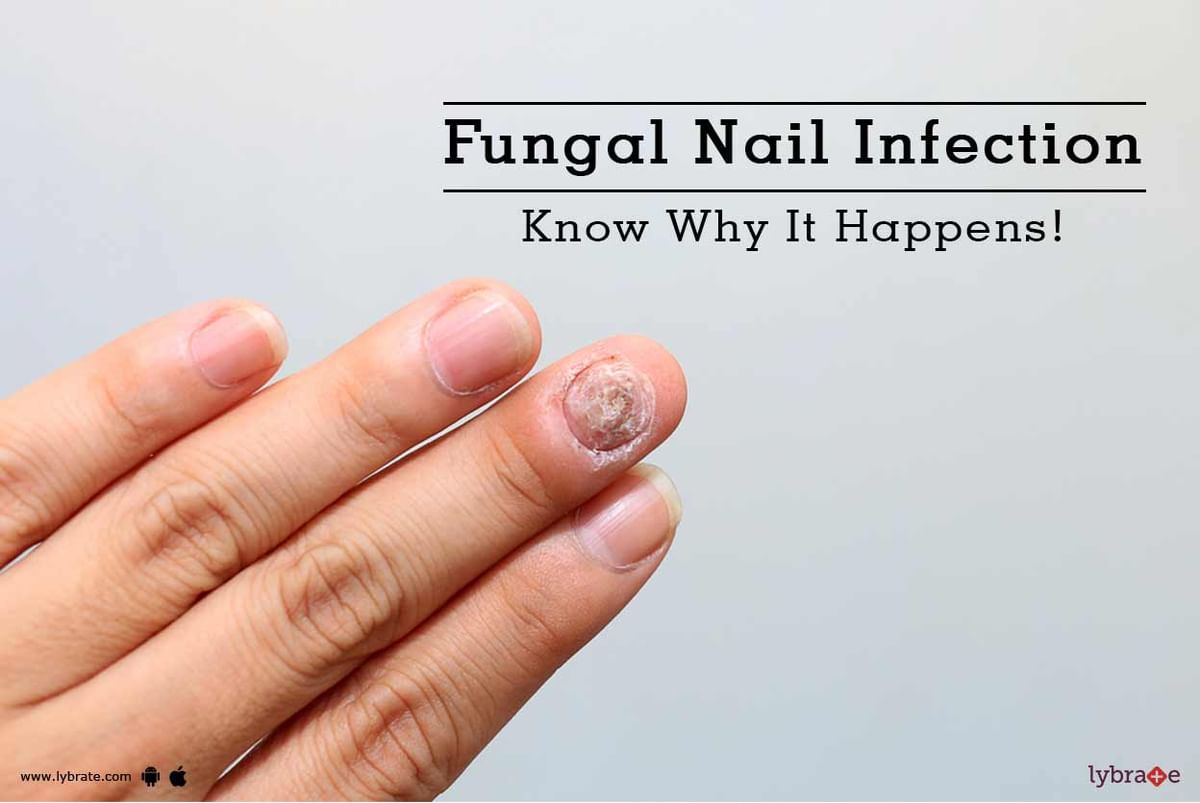Fungal Nail Infection - Know Why It Happens! - By Dr. Rashmi S | Lybrate