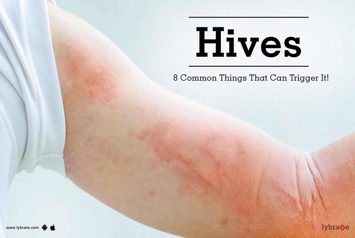 Hives 8 Common Things That Can Trigger It By Dr Ashutosh Mehta Lybrate 6693