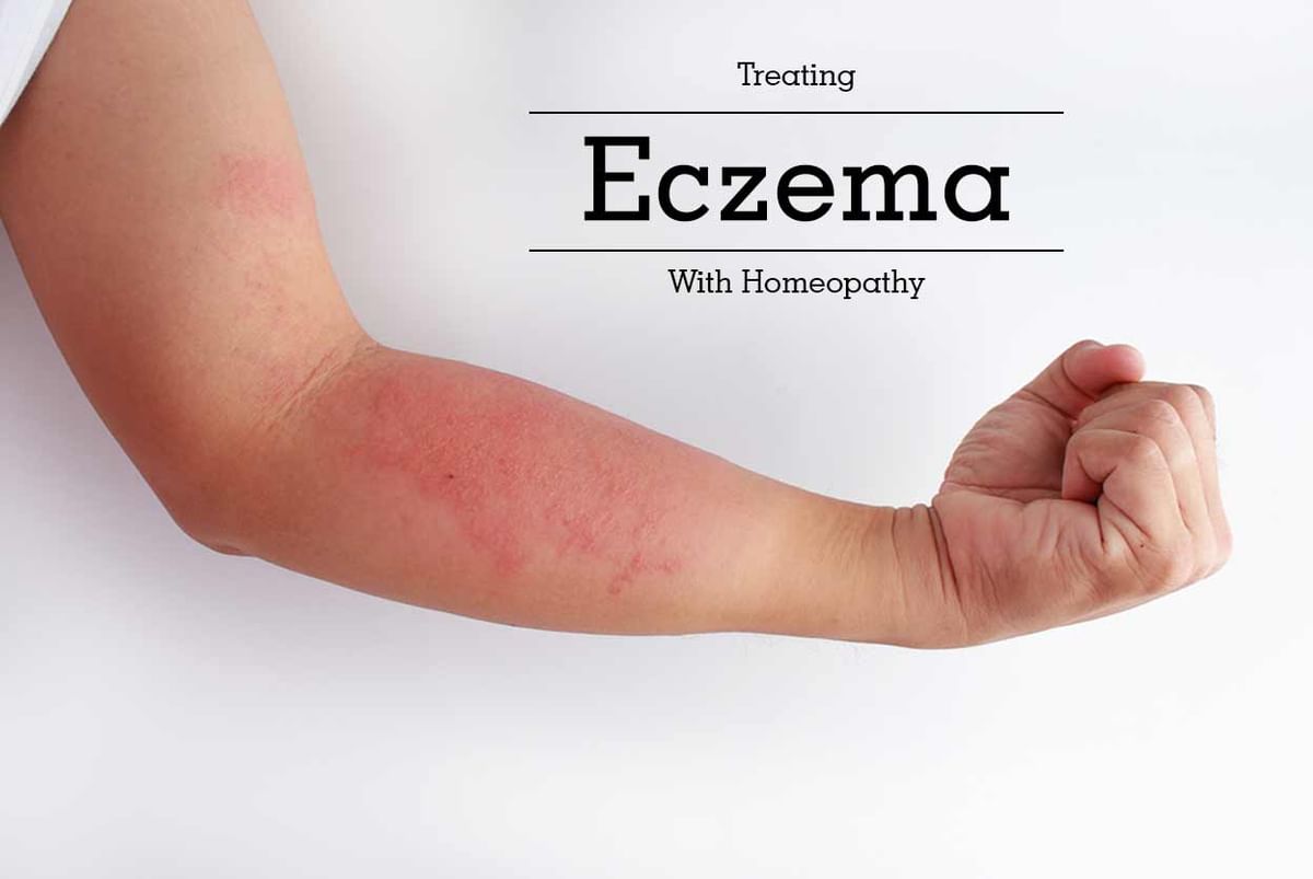 Treating Eczema With Homeopathy - By Dr. Anushri Banik