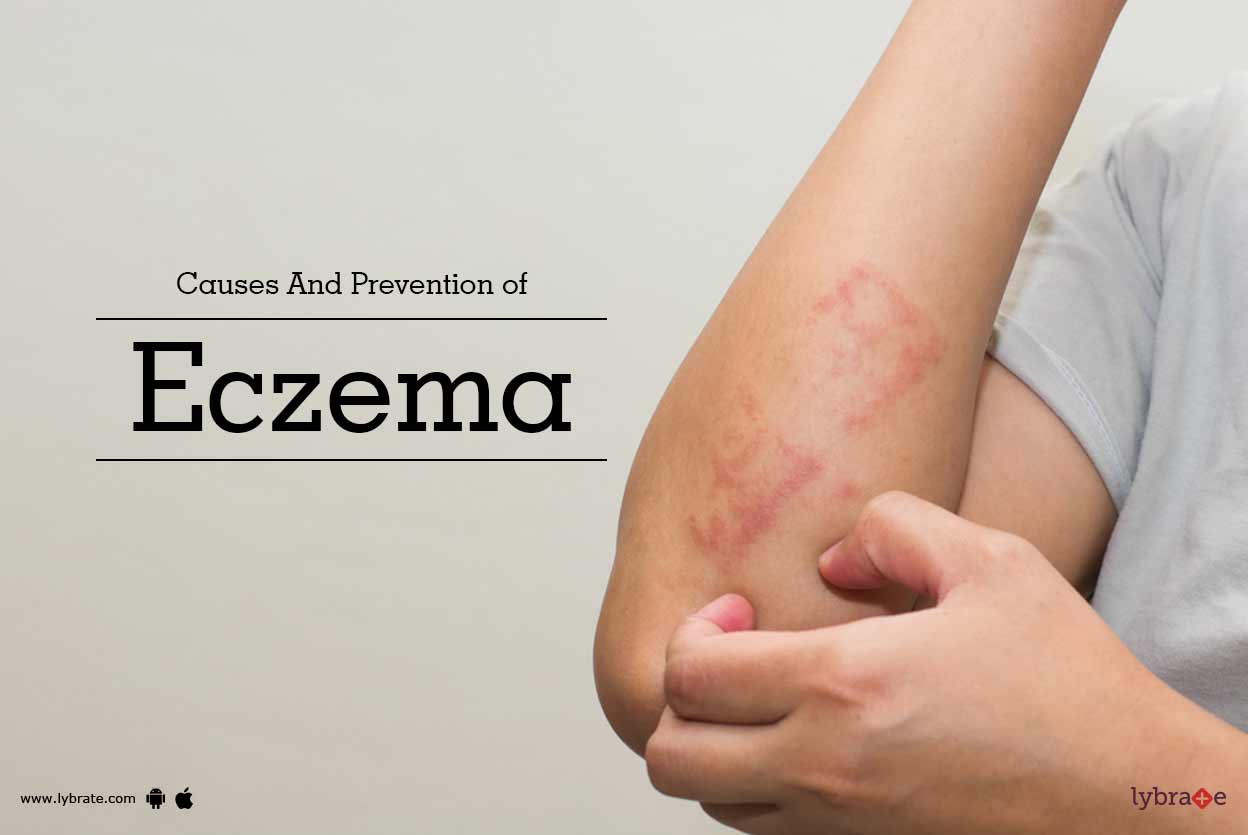 Causes And Prevention of Eczema By Dr. Deepshikha Parihar Lybrate