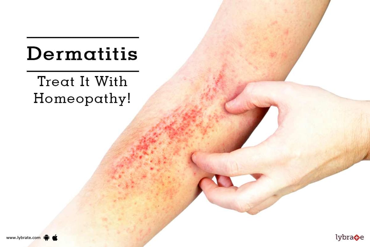 Dermatitis Treat It With Homeopathy By Dr Abha Gupta Lybrate 