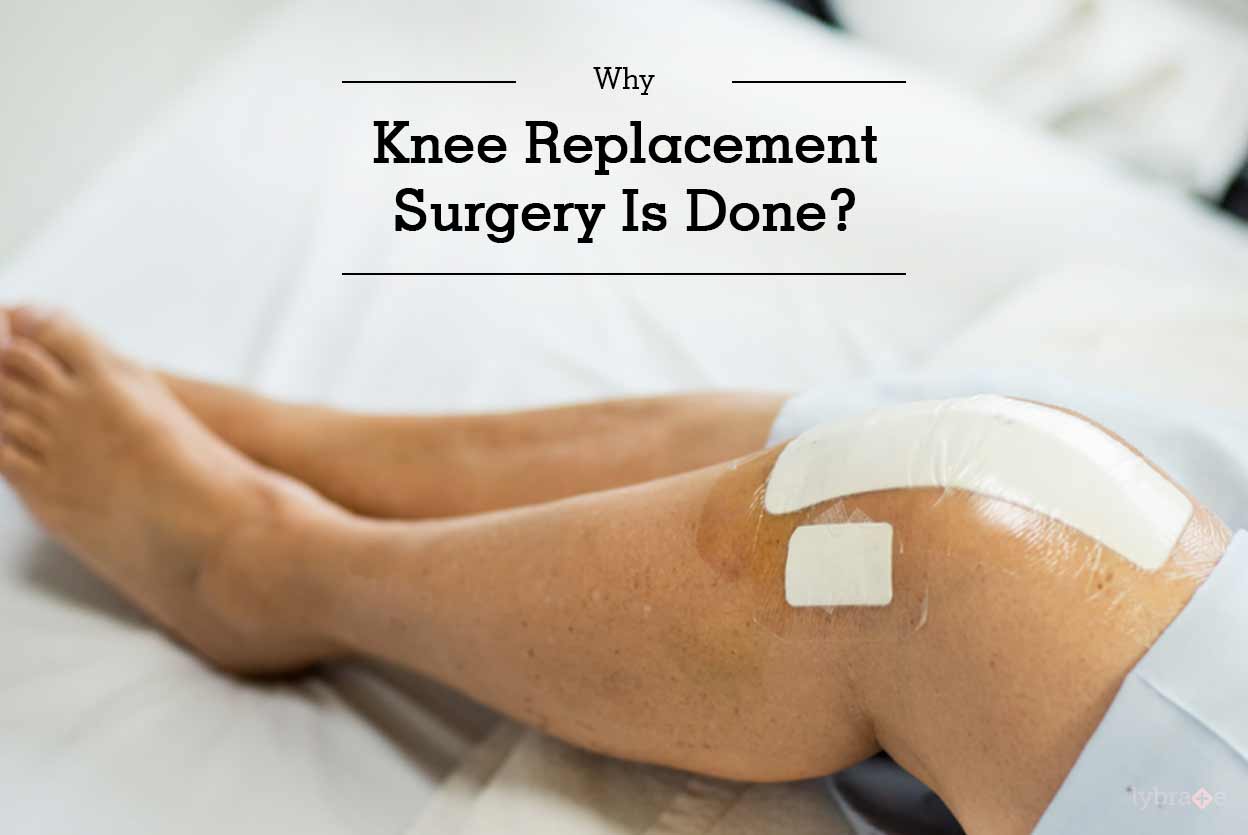 Why Knee Replacement Surgery Is Done? By Dr. Sanjay Kapoor Lybrate