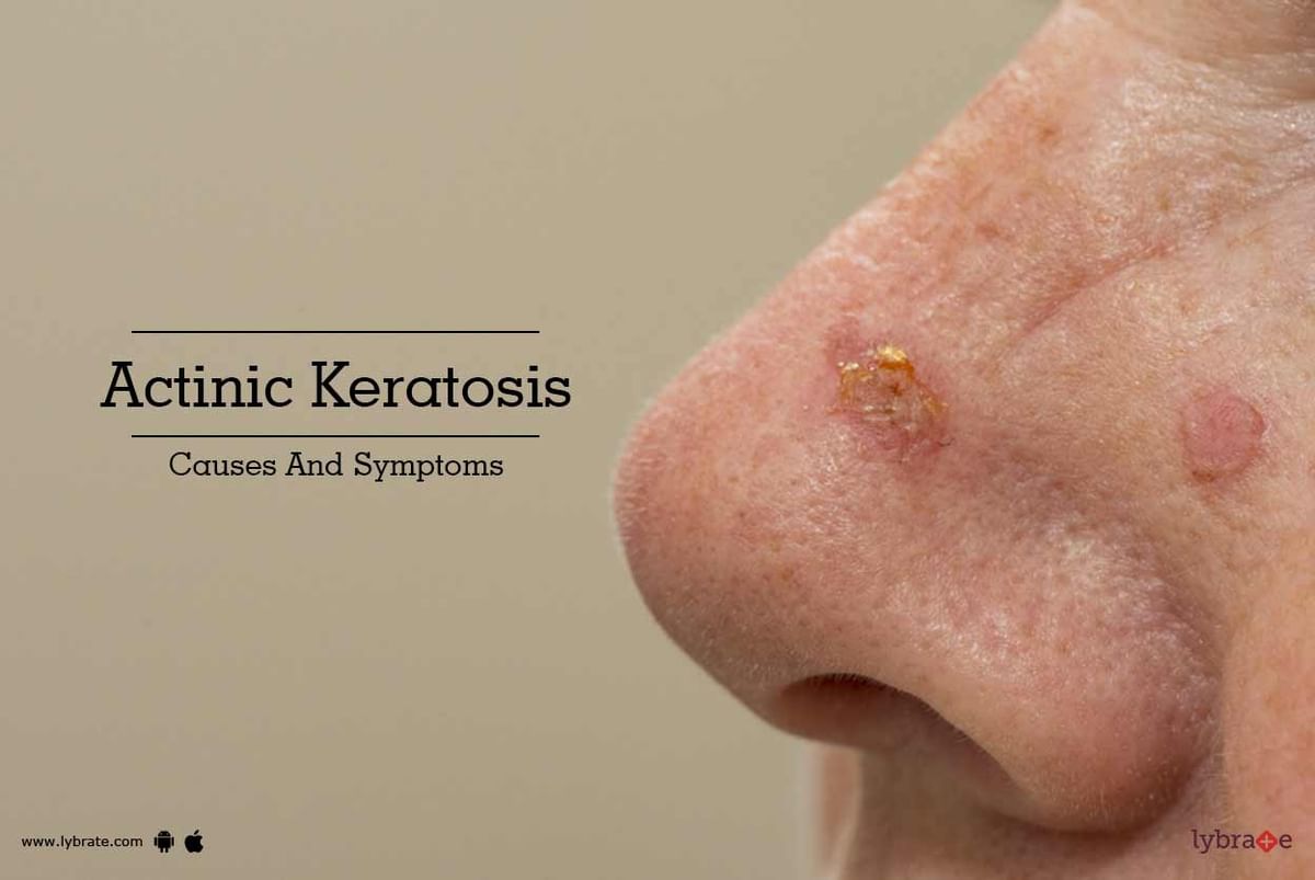 Actinic Keratosis Causes And Symptoms By Dr Amitoj Garg Lybrate 4637