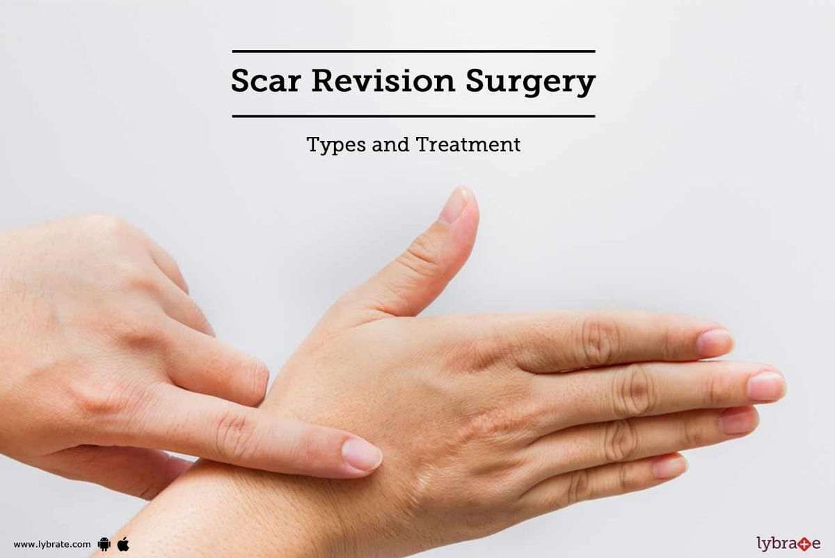 Scar Revision Surgery: Types And Treatment - By Dr. Sumeet Jaiswal ...