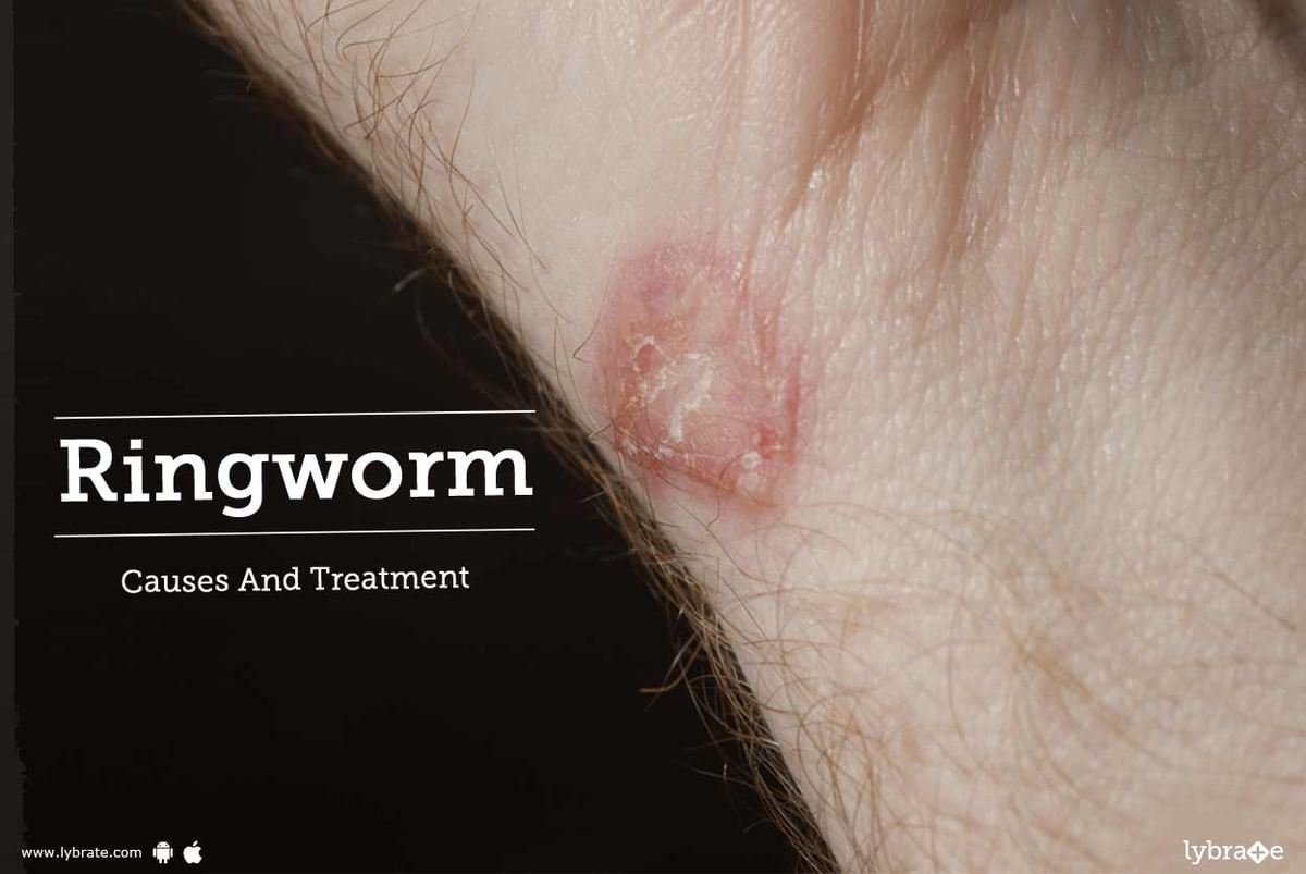 Ringworm - Causes And Treatment - By Dr. Keyur Shah | Lybrate