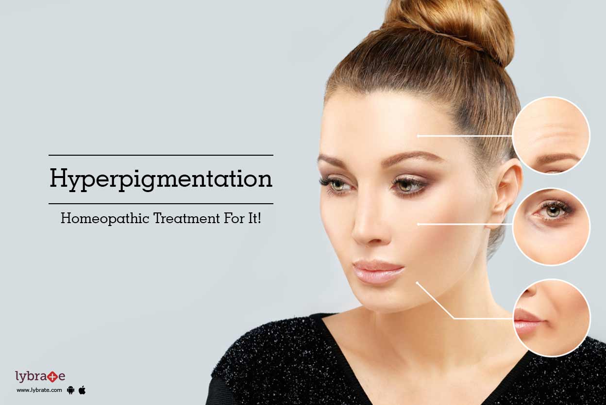 Hyperpigmentation Homeopathic Treatment For It! By Dr. Chhandanika