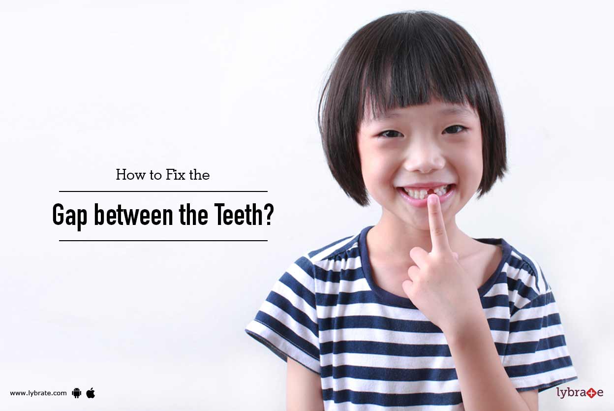 How to Fix the Gap between the Teeth? By Dr. Mallesh S A Lybrate