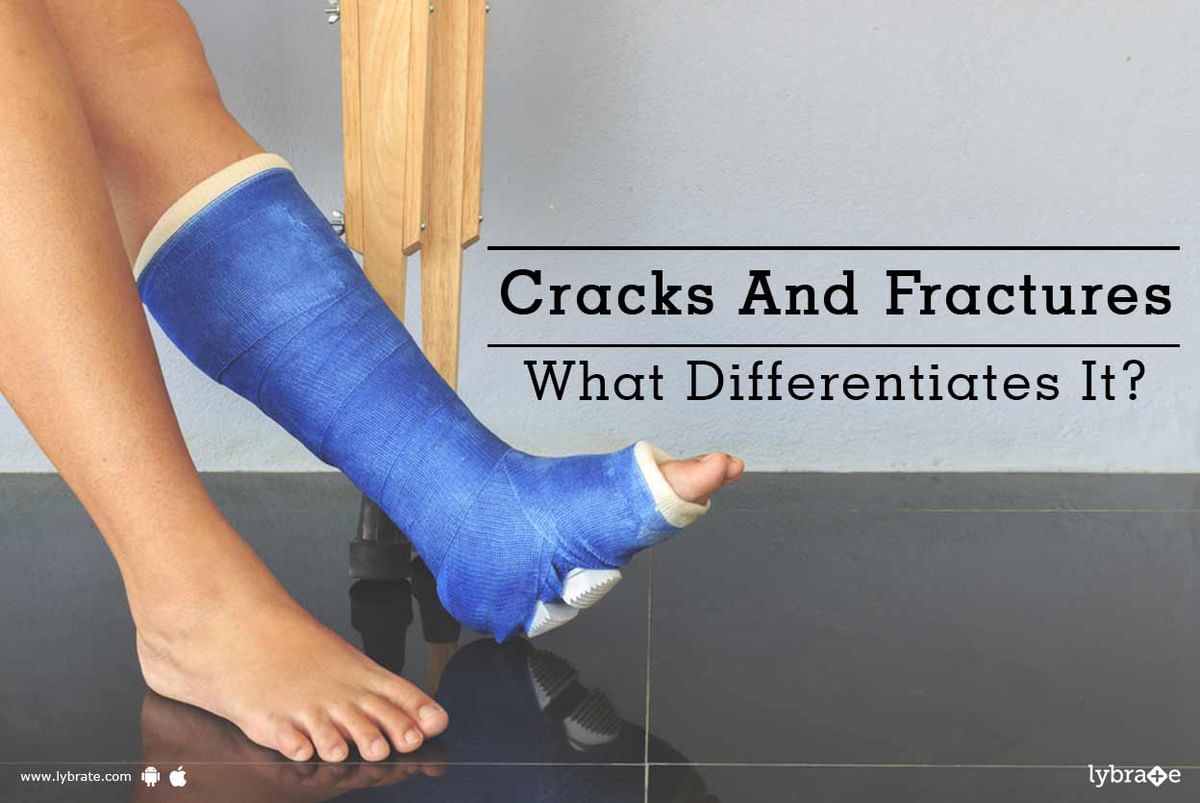 Cracks And Fractures - What Differentiates It? - By Dr. Neelabh | Lybrate