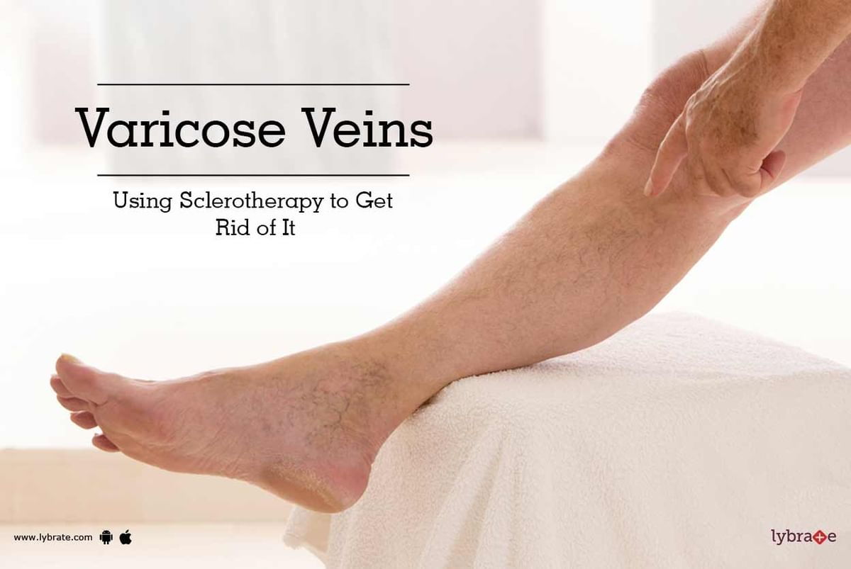Top 10 ways to prevent varicose veins - Pristyn Care