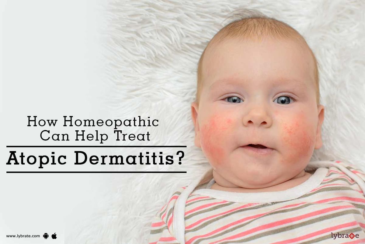 How Homeopathic Can Help Treat Atopic Dermatitis By Dr Jagmati Singh Lybrate