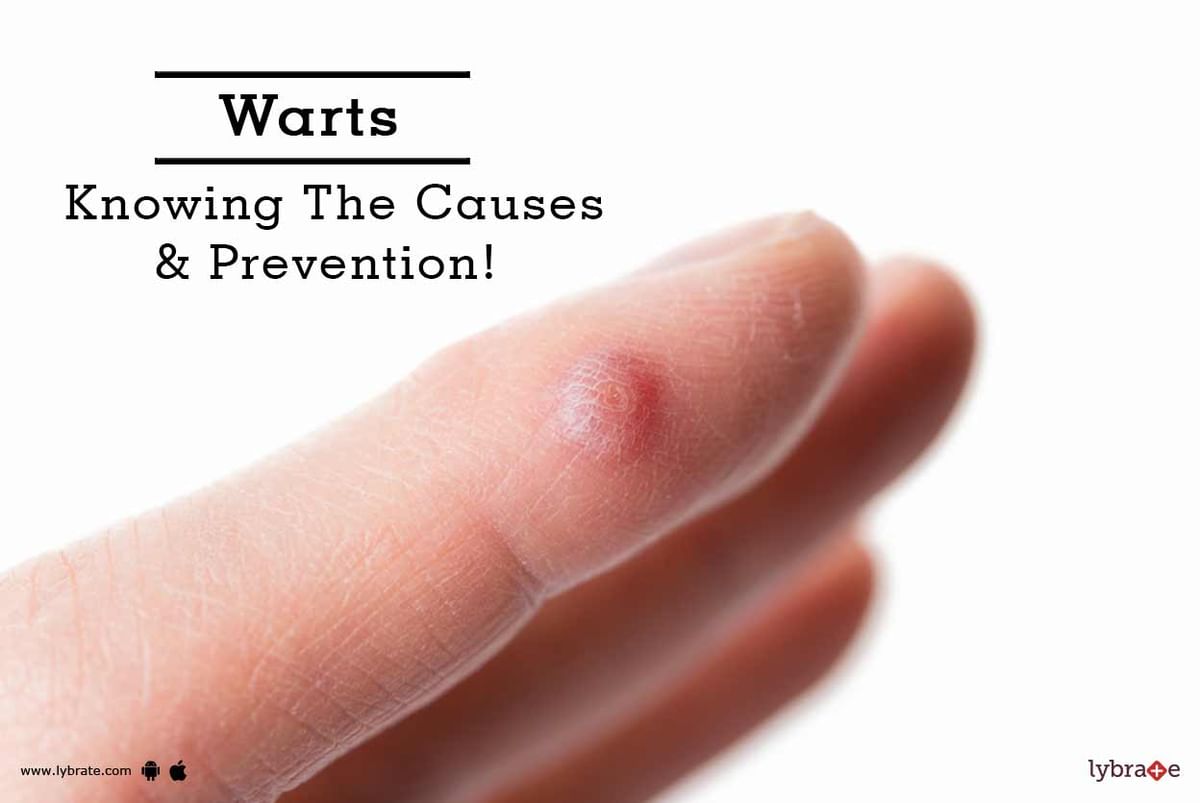 Warts Knowing The Causes And Prevention By Dr Sandeep Gupta The Dermatologist Lybrate 