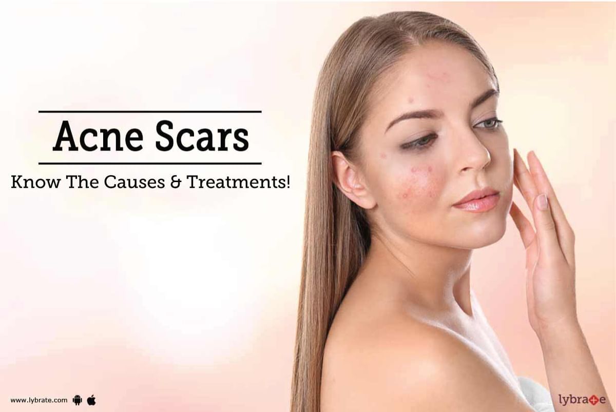 Acne Scars - Know The Causes & Treatments! - By Dr. Sarita Tippannawar ...