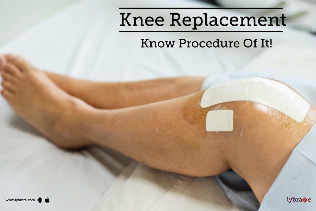 Knee Replacement - Know Procedure Of It! - By Dr. Bappaditya Sarkar ...