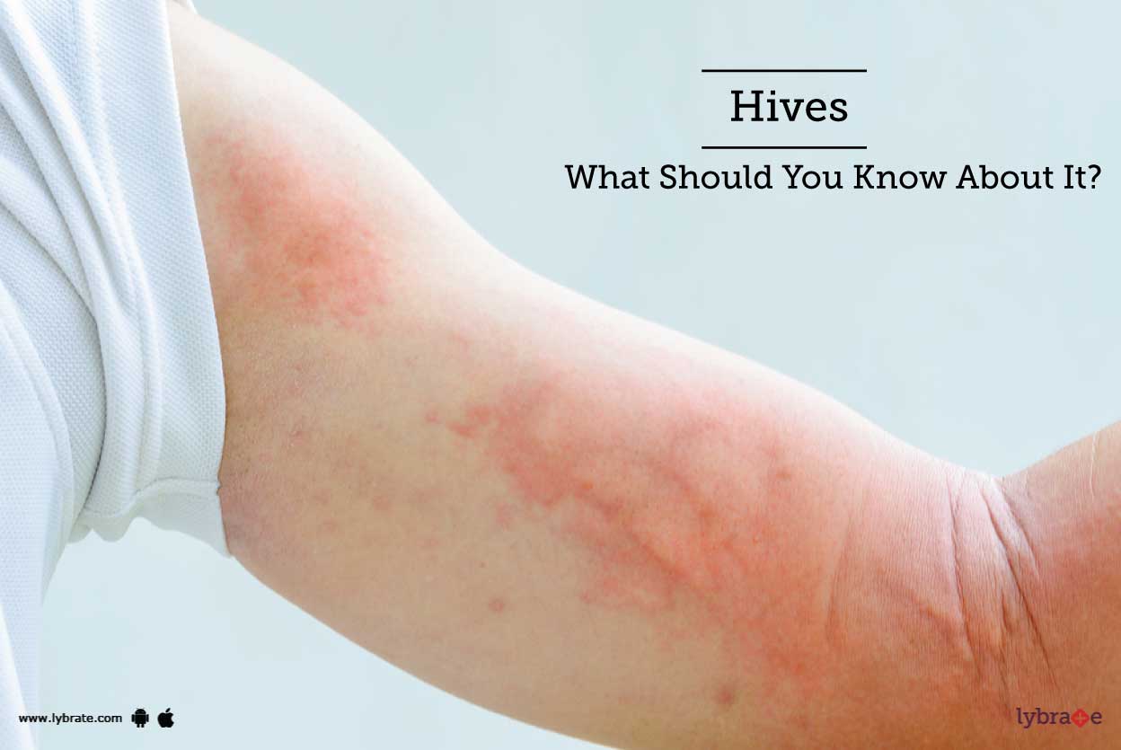 Hives What Should You Know About It? By Dr. Niraj Jain Lybrate