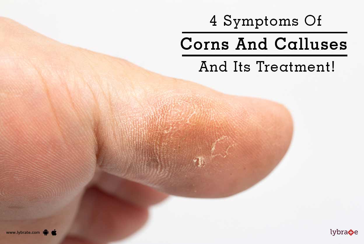4 Symptoms Of Corns And Calluses And Its Treatment! By Dr. Priyali