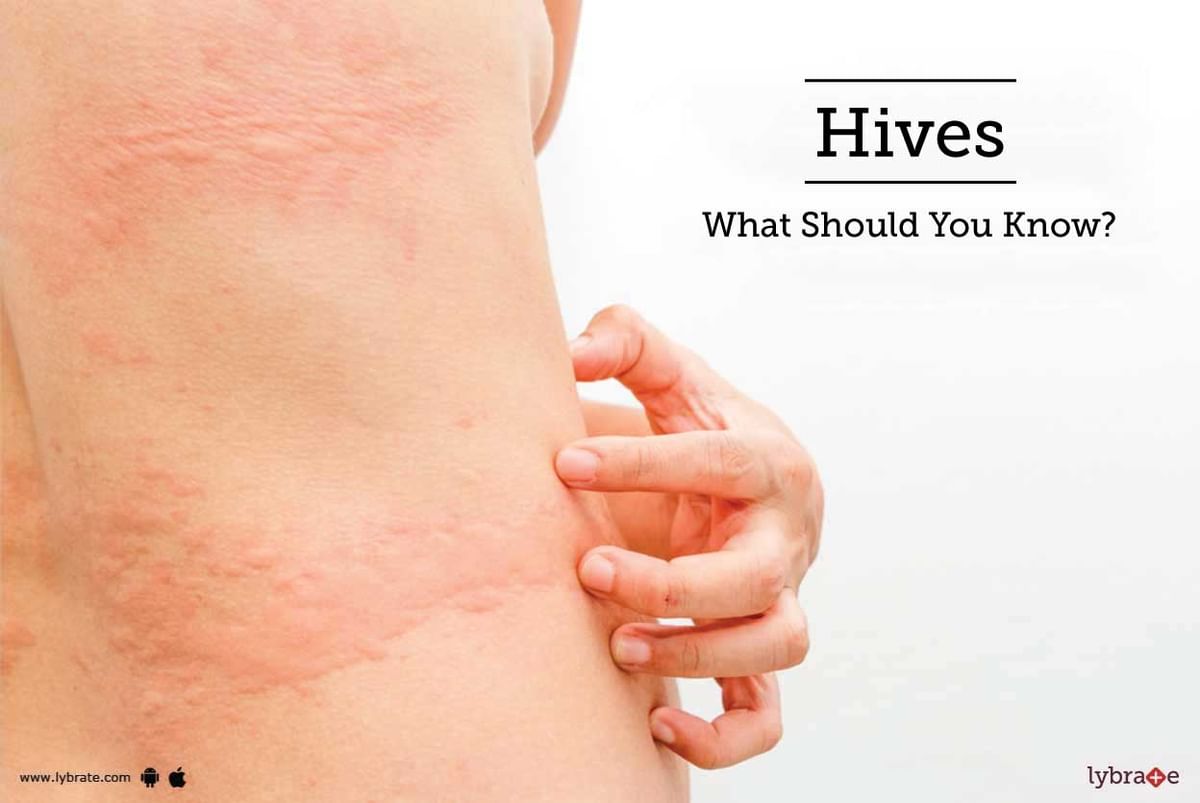 Hives - What Should You Know? - By Dr. Rashmi Lohiya | Lybrate