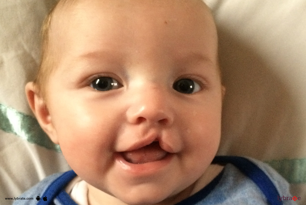 Reconstructive Surgery For Cleft Palate Know More About It! By Dr