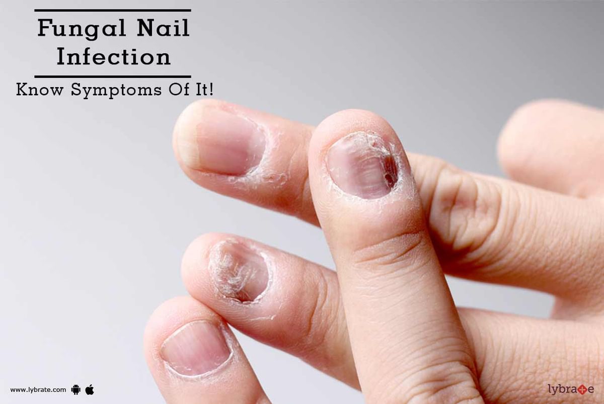 Is Nail Fungus Contagious? Preventing Toenail & Fingernail Fungus