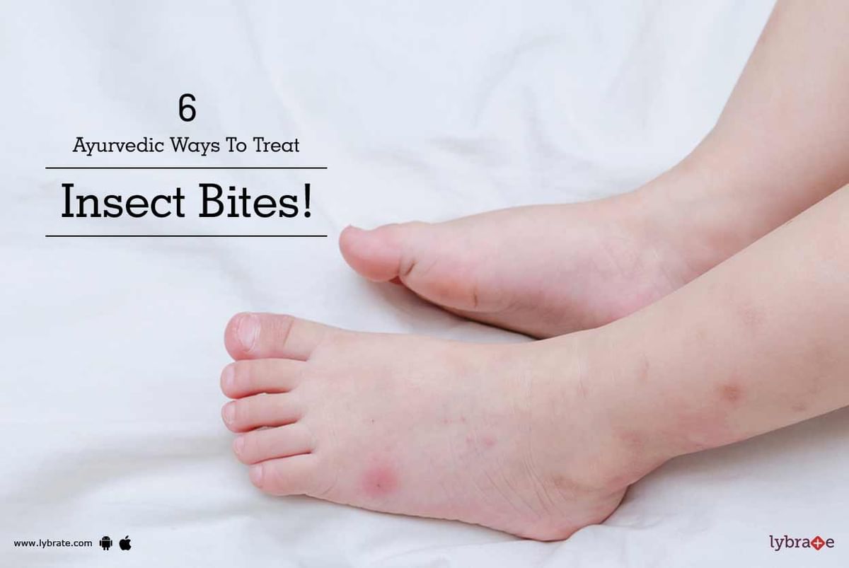 Principles of the insect bite treatment