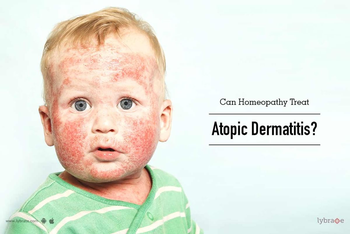 Can Homeopathy Treat Atopic Dermatitis By Dr Arghya Majumder Lybrate