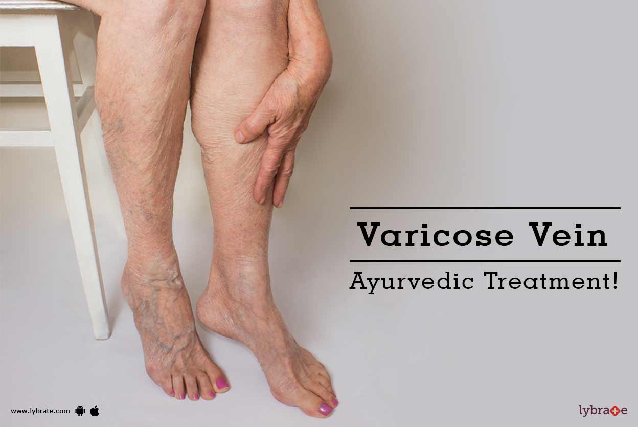 Varicose Vein Ayurvedic Treatment! By Dr. Mamta Kumari Lybrate