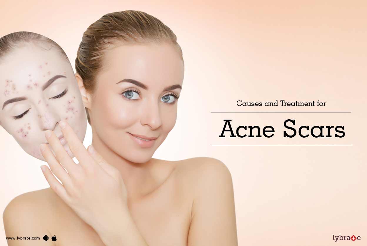 Causes and Treatment for Acne Scars By Dr. Ashima Goel Lybrate