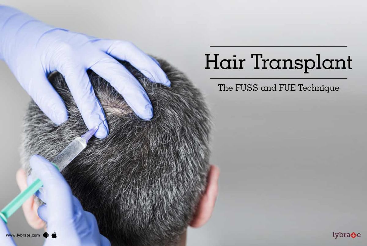 Hair Transplant - The FUSS and FUE Technique - By Dr Sunakshi Singh Singh |  Lybrate