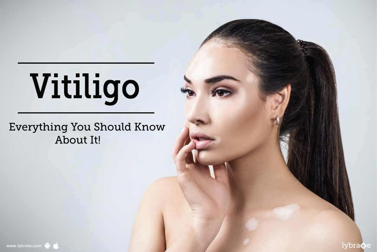 Vitiligo - Everything You Should Know About It! - By Dr. Ravish Kamal ...